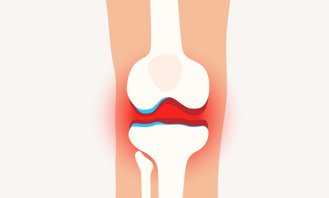 ヒアルロン酸がなくなるとまた痛みが発生