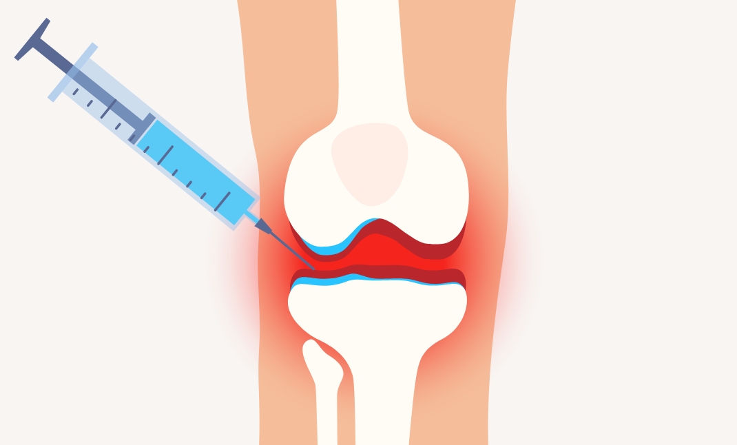 患者様の血液or脂肪を採取し、PRPor幹細胞をひざ関節に注入