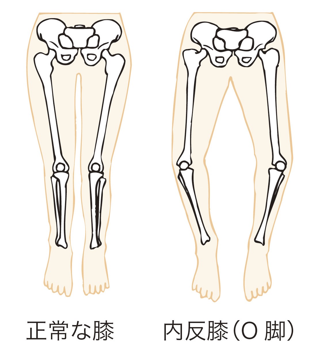 O脚の原因とは？症状・改善方法・再生医療まで専門医が解説 - 札幌ひざのセルクリニック｜変形性膝関節症・手術しない膝治療