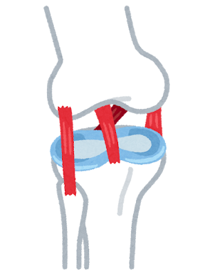半月板損傷でやってはいけないことは？