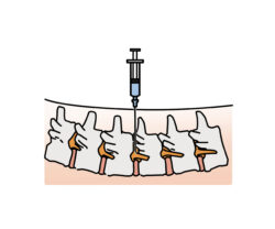 腰椎椎間板ヘルニアの治療～ブロック注射とは？