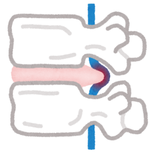 椎間板ヘルニアの原因と対処法