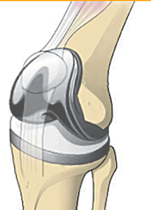 膝の手術リスクでよくある7つの質問に専門医が回答｜手術の前に知っておくべきこと