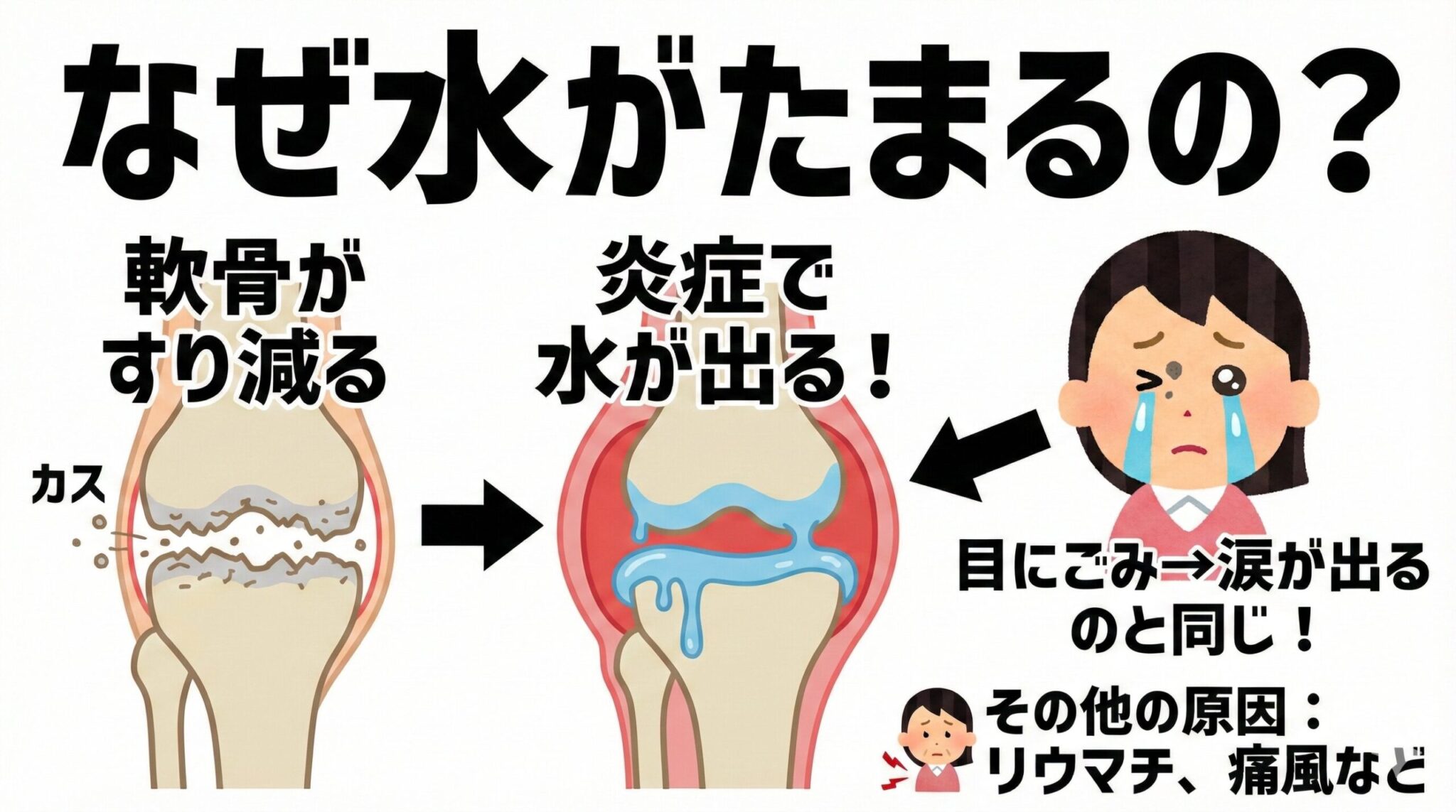 「膝に水がたまる」のはなぜ？抜くと癖になるって本当？原因と対処法を専門医 …