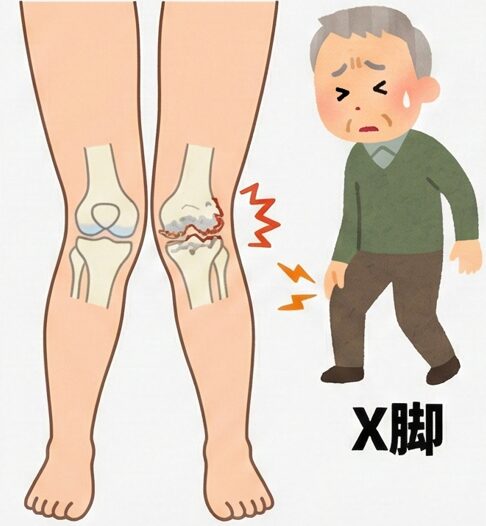 膝の外側の痛み、原因は何？歩くたびに響く痛みの正体と治し方を専門医が解説