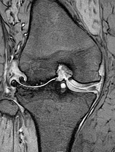 症例22　階段の上り下りや立ち上がりが楽になり、念願のテニスにも復帰できました（70代 女性）