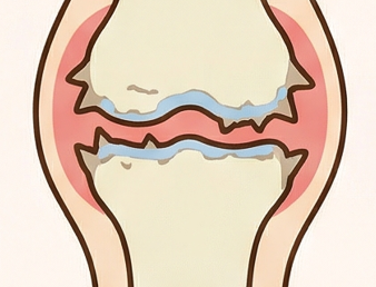 膝の骨棘でよくある8つの質問に専門医がやさしく回答
