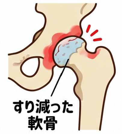 股関節がポキポキ鳴る高齢者の原因は？痛み・違和感の受診目安を整形外科専門医が解説